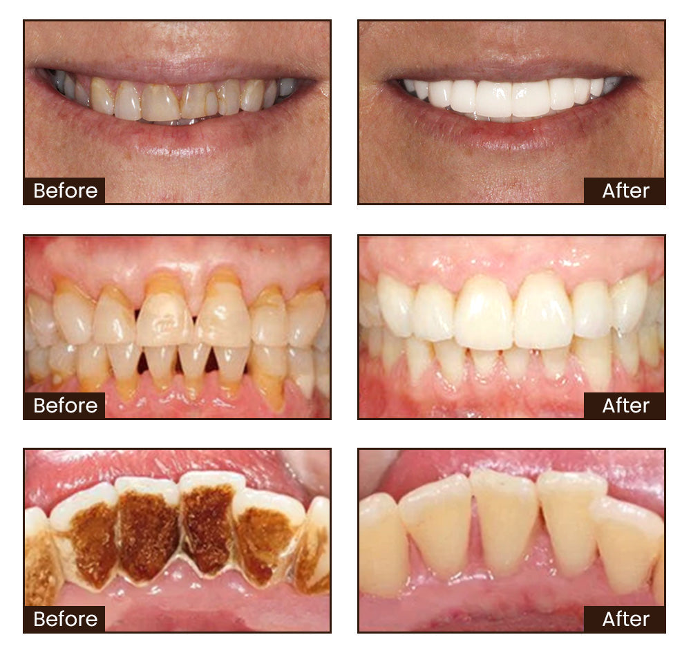 Last day buy one get one freeđڎăđĽTriple WhiteningăBBOJI⢠Nicotinamide Whitening Toothpaste