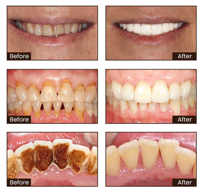 Last day buy one get one free🦷【🔥Triple Whitening】BBOJI™ Nicotinamide Whitening Toothpaste