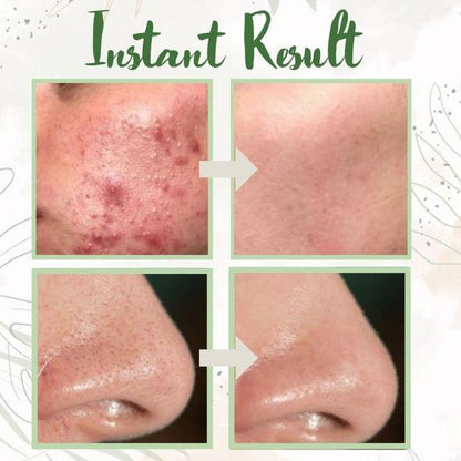 Final Sale（🔥LAST DAY SALE-80% OFF) -LOVILDS™  Green Tea Deep Cleanse Mask